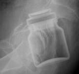 Un bărbat a ajuns la Urgențe cu un borcan în anus după ce în urmă cu un an și-a introdus un pahar în același loc